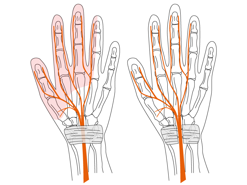 Carpal Tunnel Syndrome — Controversies and Challenges in Assessment of Post-Surgical Impairment and disability