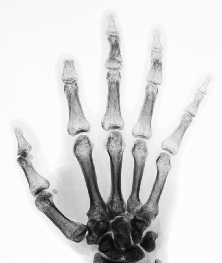 Hand Stability Test Functional stability after finger amputation – considerations in ...